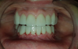 De-Vos-Dental-Crowns1-AFTER