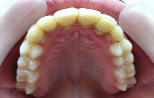 De-Vos-Dental-Fastbraces2-AFTER