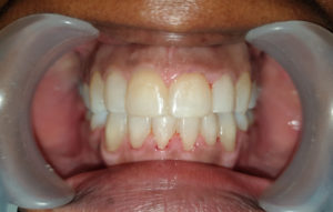 De-Vos-Dental-Fastbraces7-AFTER