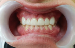 De-Vos-Dental-Orthodontics-AFTER