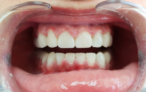 De-Vos-Dental-Rehab3-AFTER