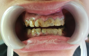 De-Vos-Dental-Rehab3-BEFORE