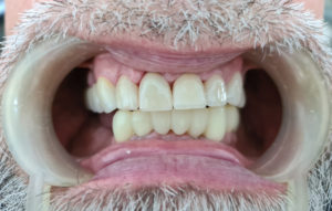 De-Vos-Dental-Rehab4-AFTER